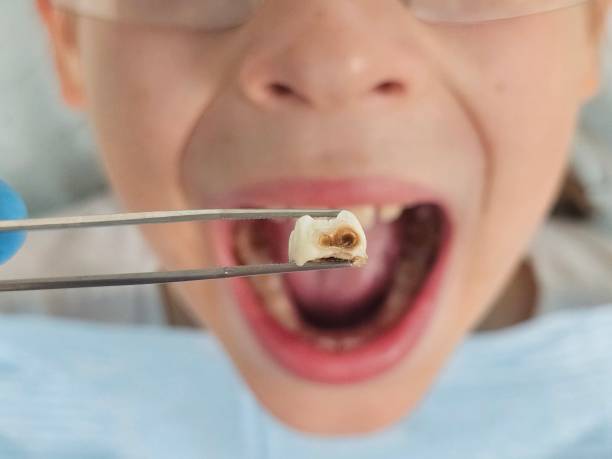 Best Dental Abscess Treatment in Jacksonville, AL