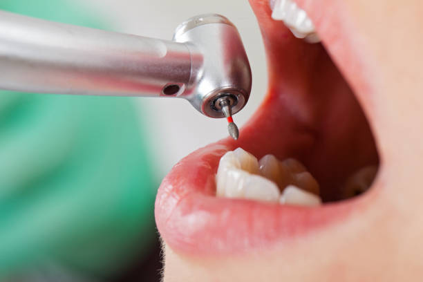 Best Emergency Wisdom Tooth Extraction in Jacksonville, AL